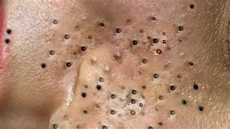 blackheads loan|loan nguyen huge blackheads 2022.